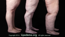 Often misdiagnosed as obesity, lipedema is a painful and body disfiguring condition affecting an estimated 11 percent of adult women in the United States. (Photo: Lipedema Foundation)